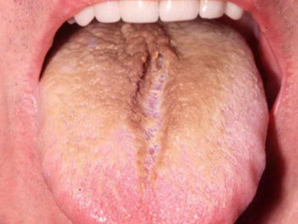 tongue color during pregnancy