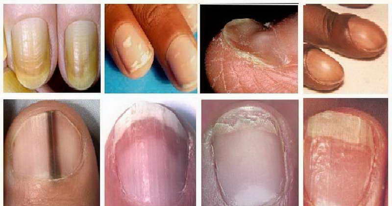 finger nail says about health 