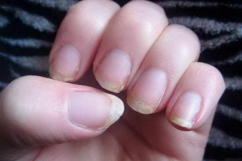 What Your Nails Say About Your Health