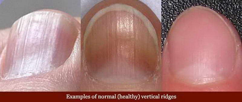 finger nail health signs and symptoms