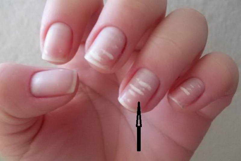 finger nail health signs meanings