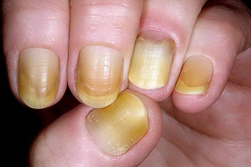 finger nail health signs uk
