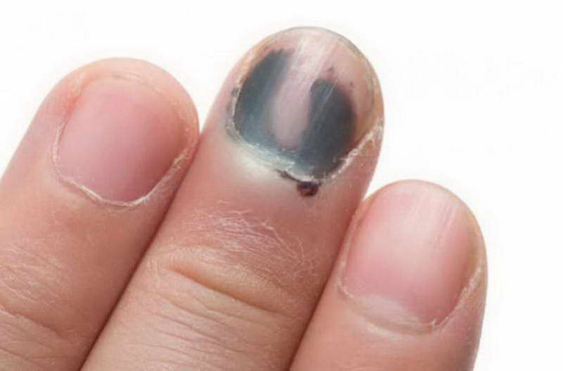 fingernail health warning signs