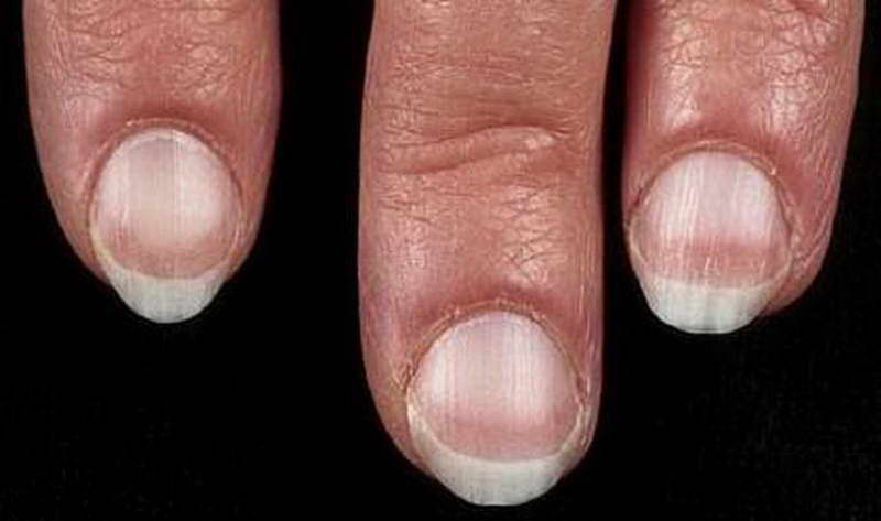 fingernail signs health problems