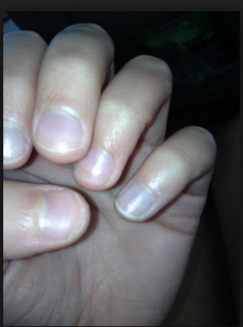 fingernail signs of bad health
