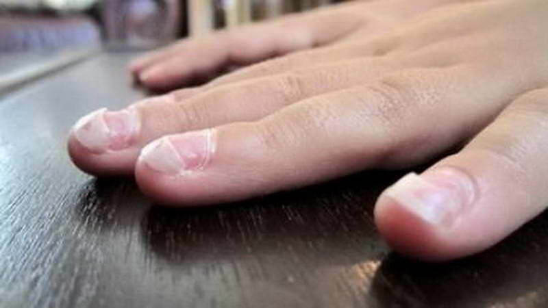 fingernail signs of health disease