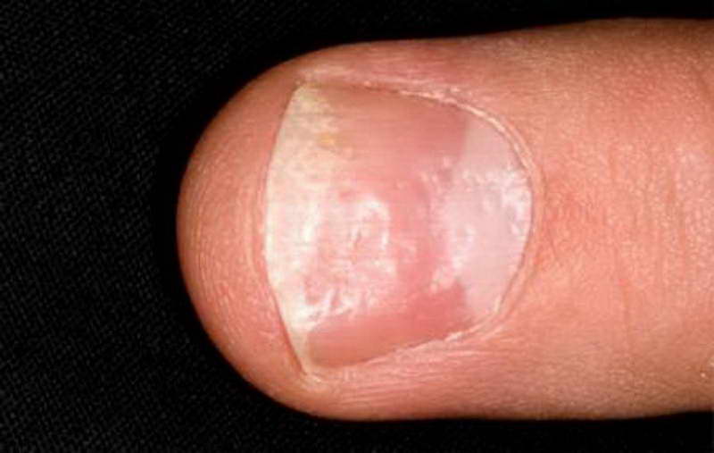finger nail health signs video